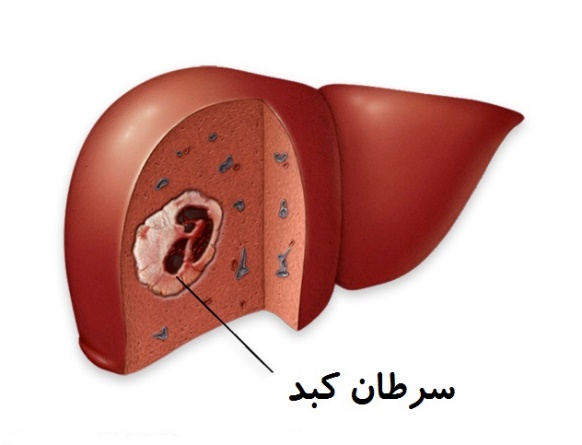 سرطان كبد